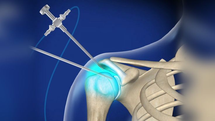 Minimally Invasive Arthroscopic Surgery for Knee & Shoulder